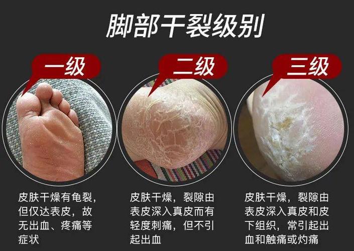足部干裂修复全攻略：还你娇嫩双足