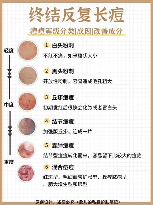 详细阅读:背部痘痘消除全攻略:告别“背痘”困扰,重拾肌肤自信 背部痘痘消除全攻略:告别“背痘”困扰,重拾肌肤自信