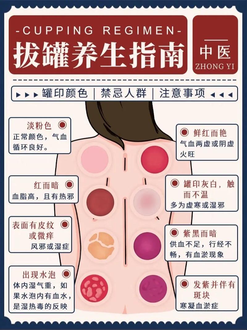 探秘拔罐：传统中医疗法的奥秘与现代应用