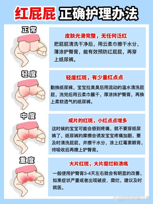 宝宝防红屁屁全攻略：守护娇嫩肌肤，让宝贝远离“红屁屁”困扰