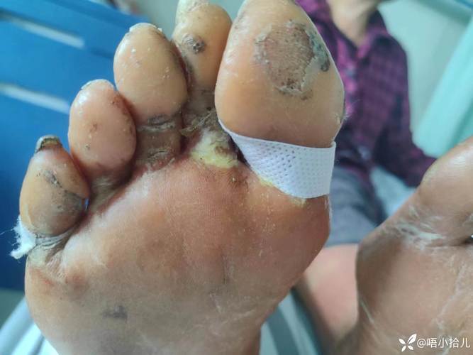糖尿病,糖尿病的症状有哪些表现