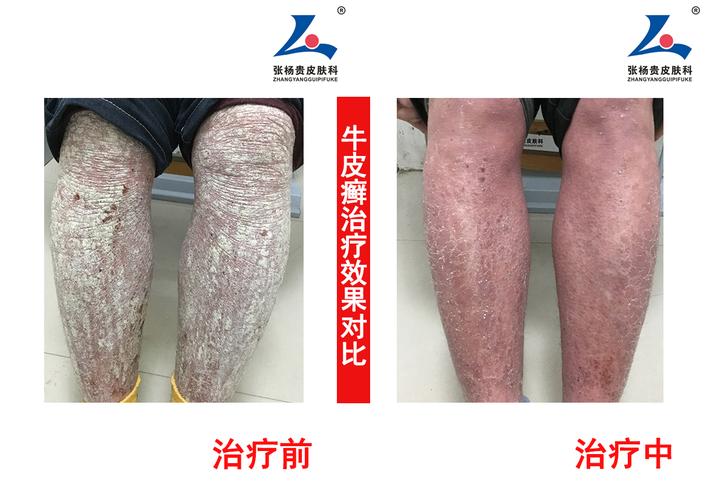 牛皮癣的治疗与控制,