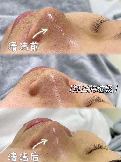 详细阅读:黑头清理技巧,黑头清理技巧视频 黑头清理技巧,黑头清理技巧视频