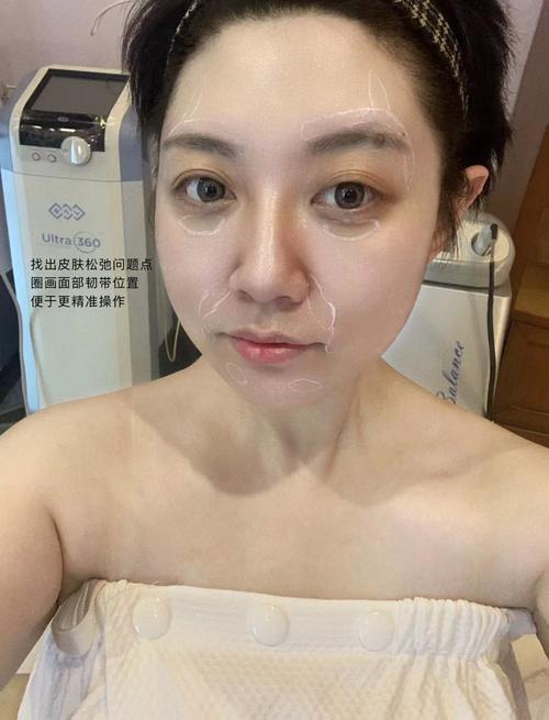 射频紧肤技术原理与应用,射频紧肤技术原理与应用视频