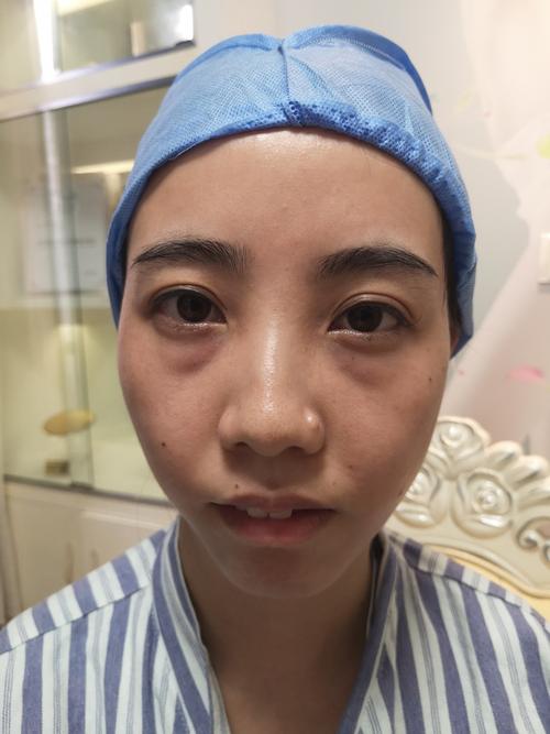 详细阅读:眼部眼袋消除,眼部眼袋消除妙招 眼部眼袋消除,眼部眼袋消除妙招